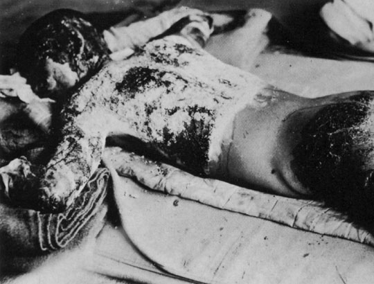 Atomic Bomb Hiroshima Effects. The Story of Hiroshima